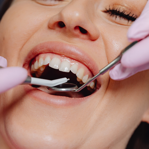 All-on-4 Dental Implants Rexburg