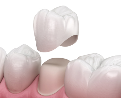 Tooth‑Color Restorations in Rexburg - Dental Services in Rexburg